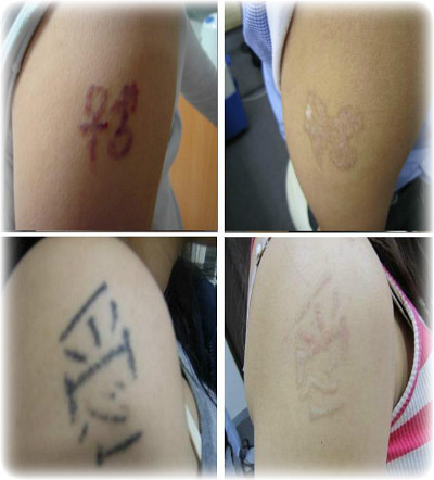 [문신제거] 꿈을 위한 청소년들의 비행! 썸네일 이미지