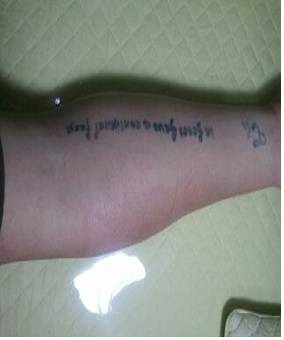 [문신제거] 문신을 왜 지워줘야 하나요? 썸네일 이미지