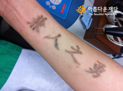 [문신제거] 소소한 일상의 행복을 찾아주는 ‘청소년 문신제거 사업’ 썸네일 이미지